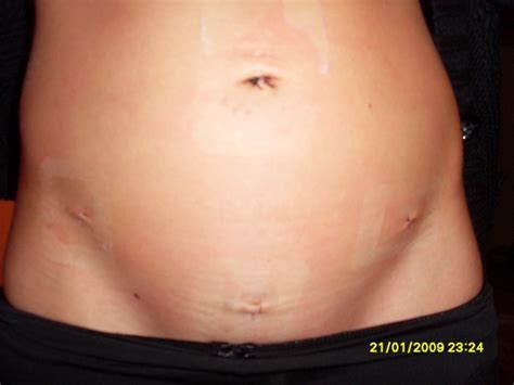 An <b>appendectomy</b> is surgery to remove the appendix. . Belly button infection after laparoscopy